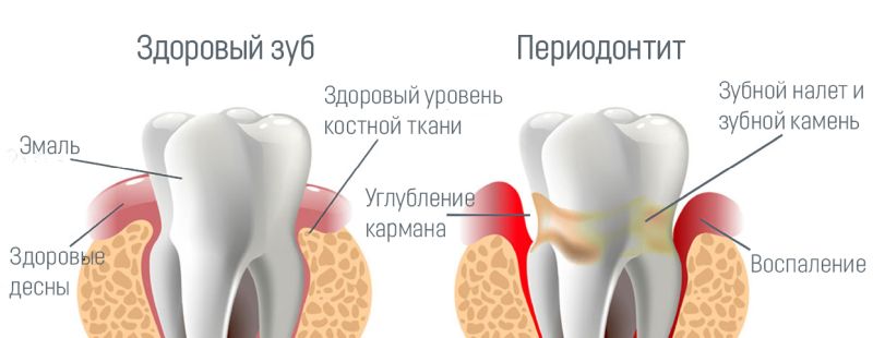 Этапы лечения периодонтита на фото